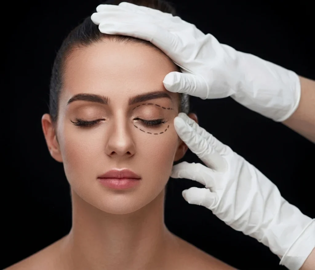 Dr Williams Siñani - Blefaroplastia resultados-2
