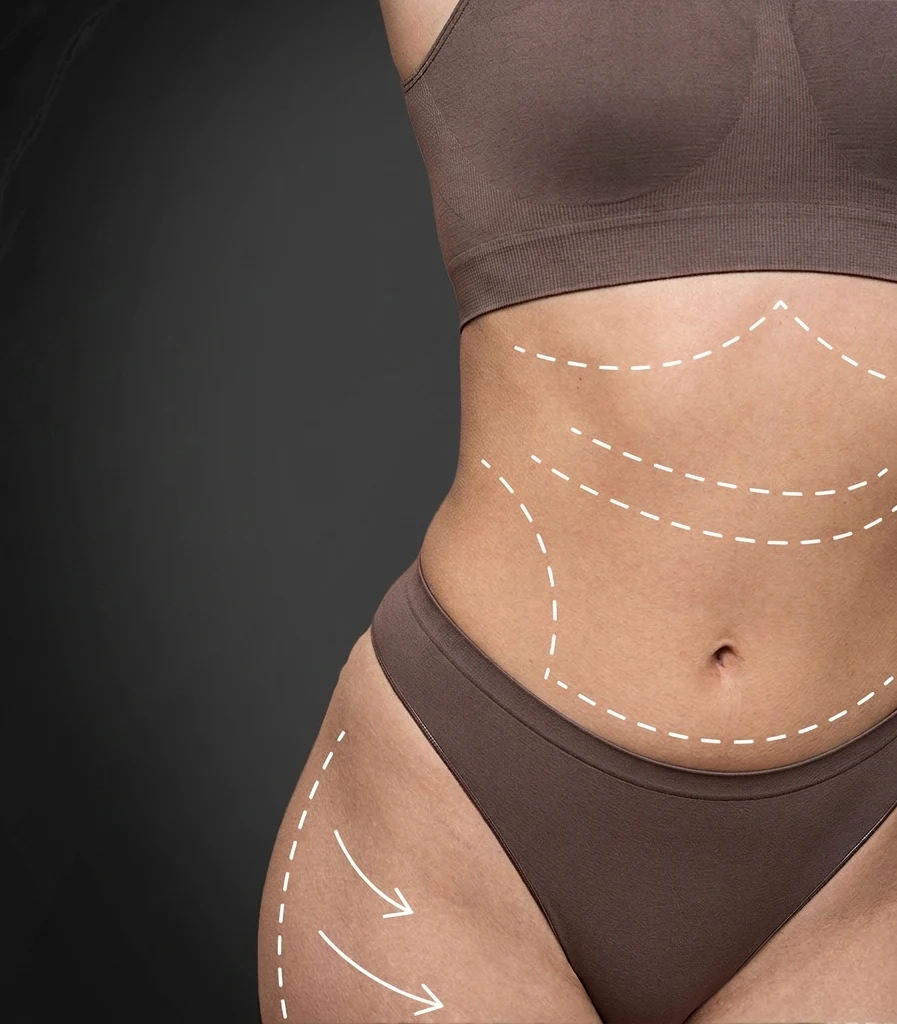 Dr Williams Siñani - Mommy makeover
