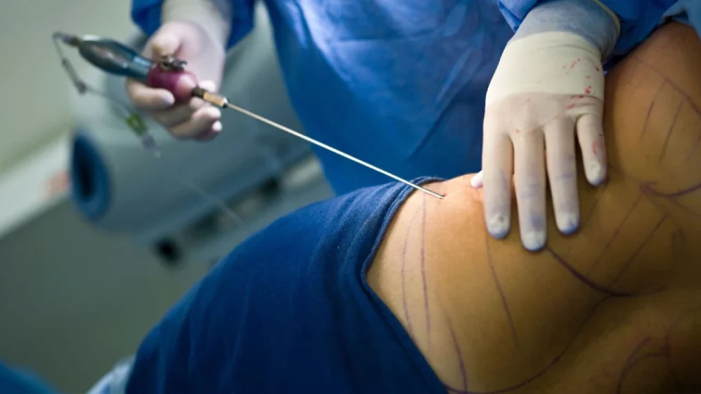 5 razones por las que la lipoescultura cambiara tu vida | Dr Williams Siñani